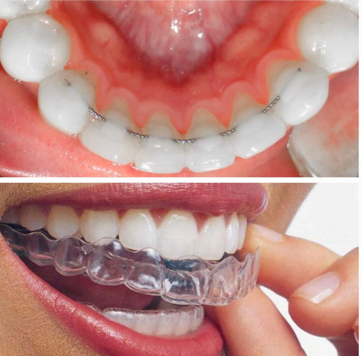 Contenciones de ortodoncia fija y removible